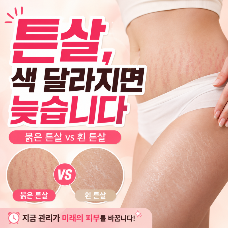 붉은튼살 흰튼살 지울수 있을까? 튼살없애는법