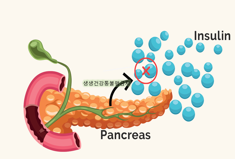 인슐린 저항성 뜻과 검사방법, 개선을 위해서는