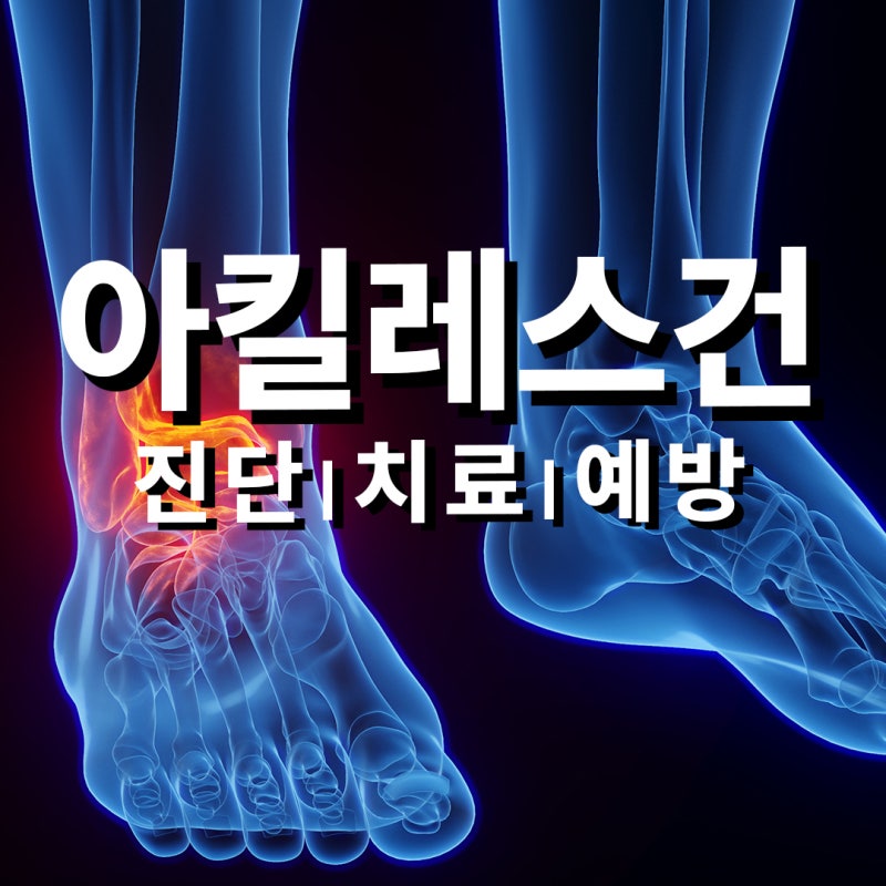 아킬레스건염, 체외충격파 치료가 도움이 될까요? 진단부터 재활까지 | 용인정형외과 용인서....