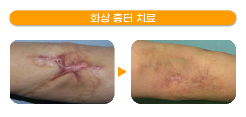 강남 화상 흉터 유형별 치료 방법!화상흉터 레이저 수술 잘하는 병원 안성열성형외과피부과