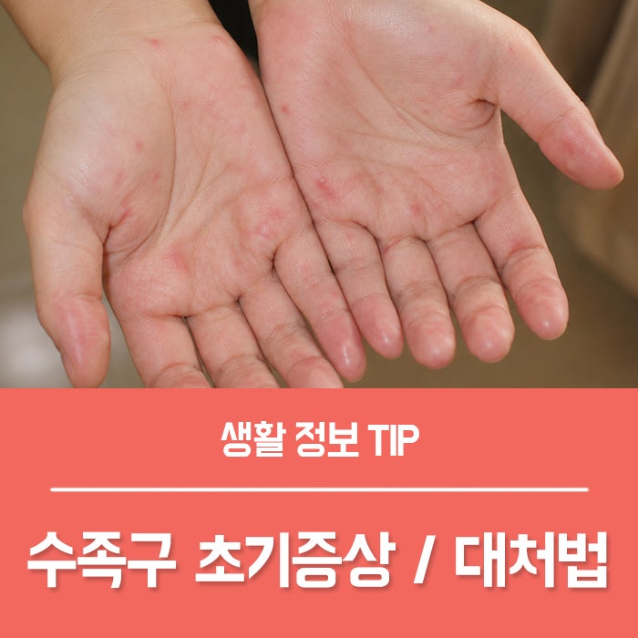 수족구 초기증상 아기 성인 수족구 증상 수족구병 원인과 대처법은?