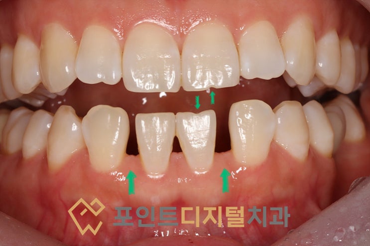[탕정치과] 하악 앞니 선천적 결손 및 앞니 벌어짐(Diastema) 바이오클리어 레진 수복 케이스 / 천안 아산