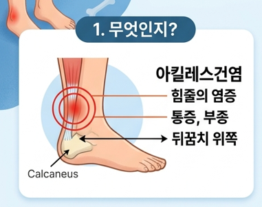 목동 통증의원, 걸을 때마다 찌릿! 아킬레스건염 원인부터 예방치료법 까지 총정리