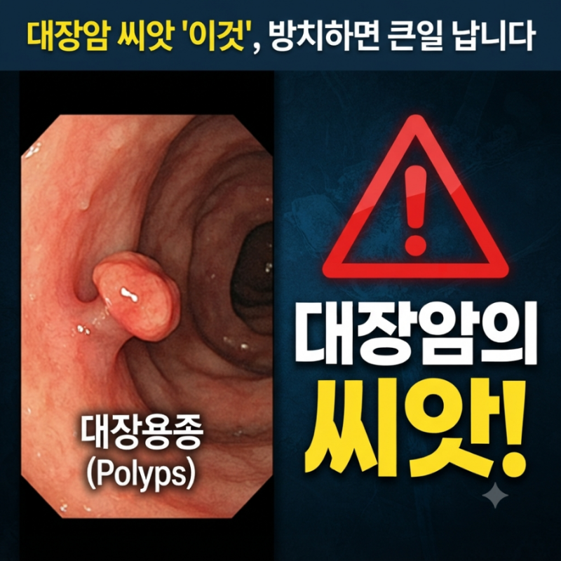 "대장암 씨앗 대장용종 생기는 원인, 이런 습관 계속되면 큰일 납니다"