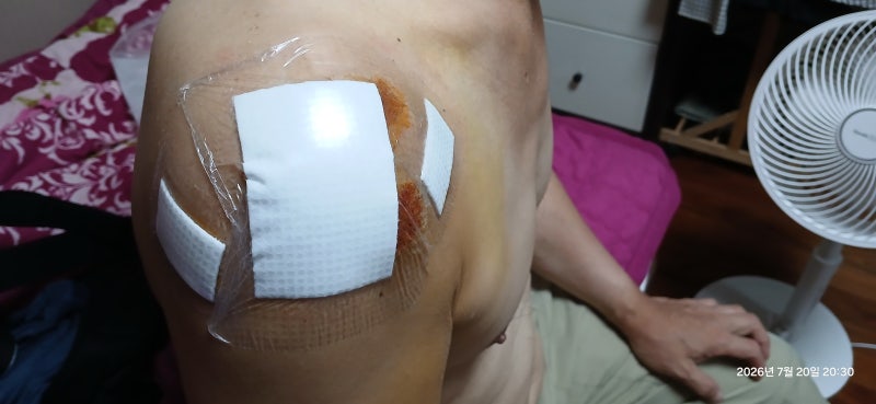 어깨 회전근개 파열의 수술,재활 정보(수술,비수술을 고민하는 환자에 대한 참고용 정보제공....
