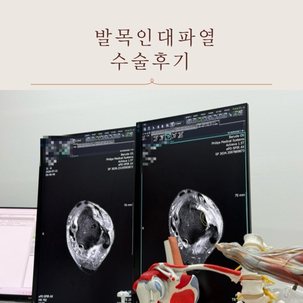 발목인대파열 수술 후기 1일차