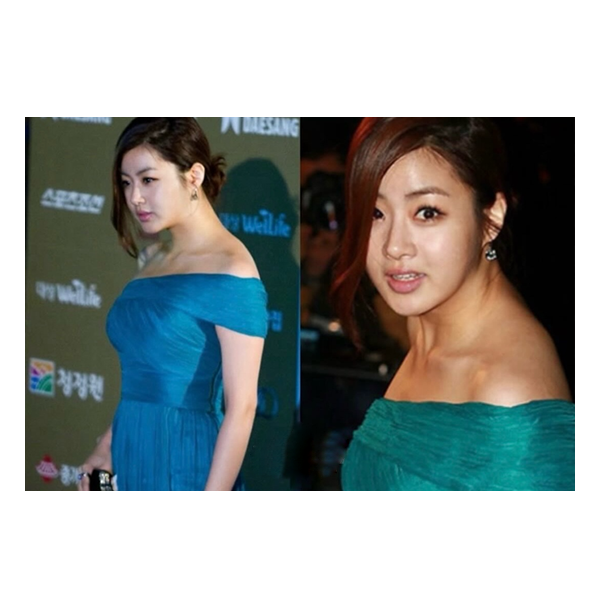 한때 거북목 엄청 심했던 강소라 다이어트 전/후 승모근 관리 정리.zip