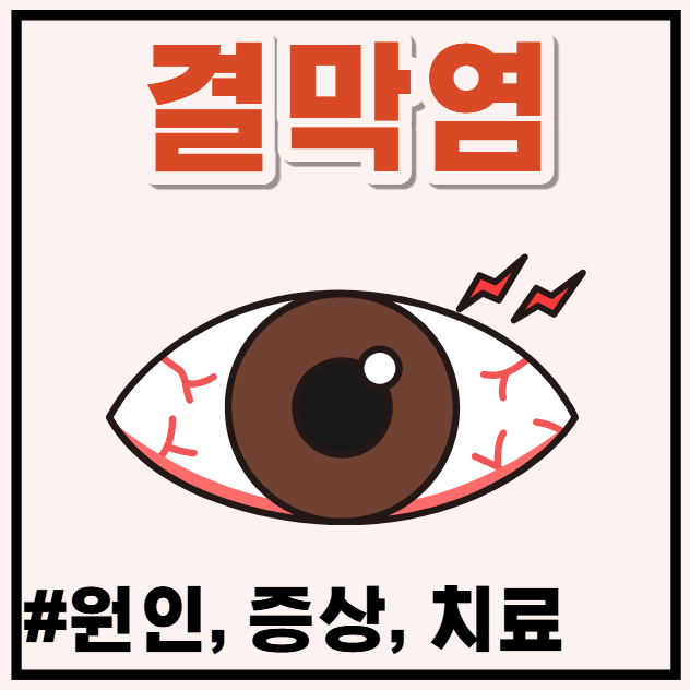 눈병 유행할 때 필수! 여름철 결막염 증상 순서와 전염 예방법 (아폴로 눈병 구분법)
