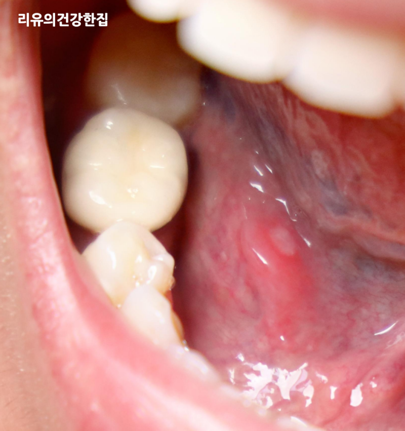 구강암 초기증상, 입병 구내염 차이 헷갈린다면!