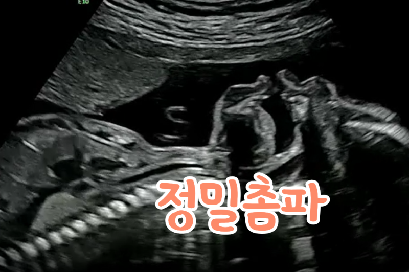 임신 20주 정밀초음파 검사시간 비용, 얼굴 심장 성별 어디까지 확인할까?