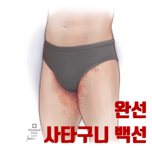 사타구니 가려움증 백선 완선, 원인 증상 약 추천, 습진 아님 주의