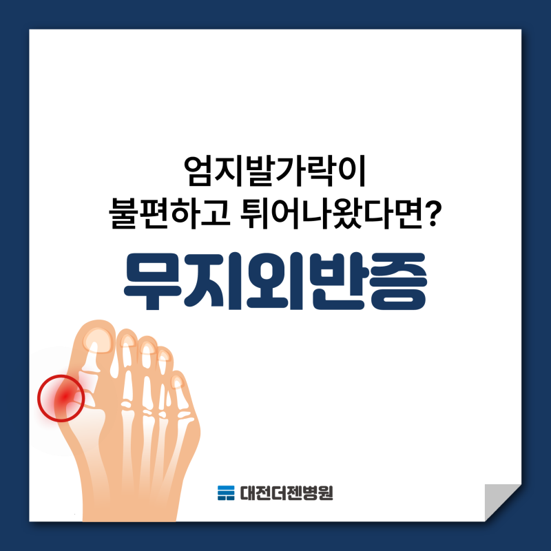 여름철에 더 스트레스! 무지외반증 대전에서 믿고 치료할 수 있는 곳?