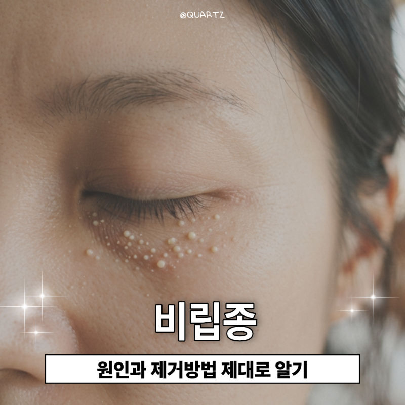 눈가 비립종 원인과 제거 방법 압출하면 안된다?