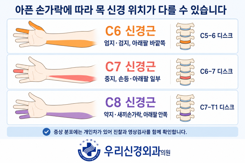 손가락이 아픈데 원인은 목디스크일 수 있습니다｜부산 우리신경외과