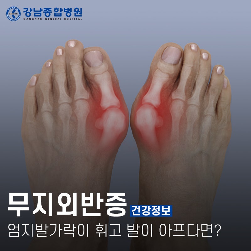대구 무지외반증 원인과 치료방법이 어떻게 되나요?