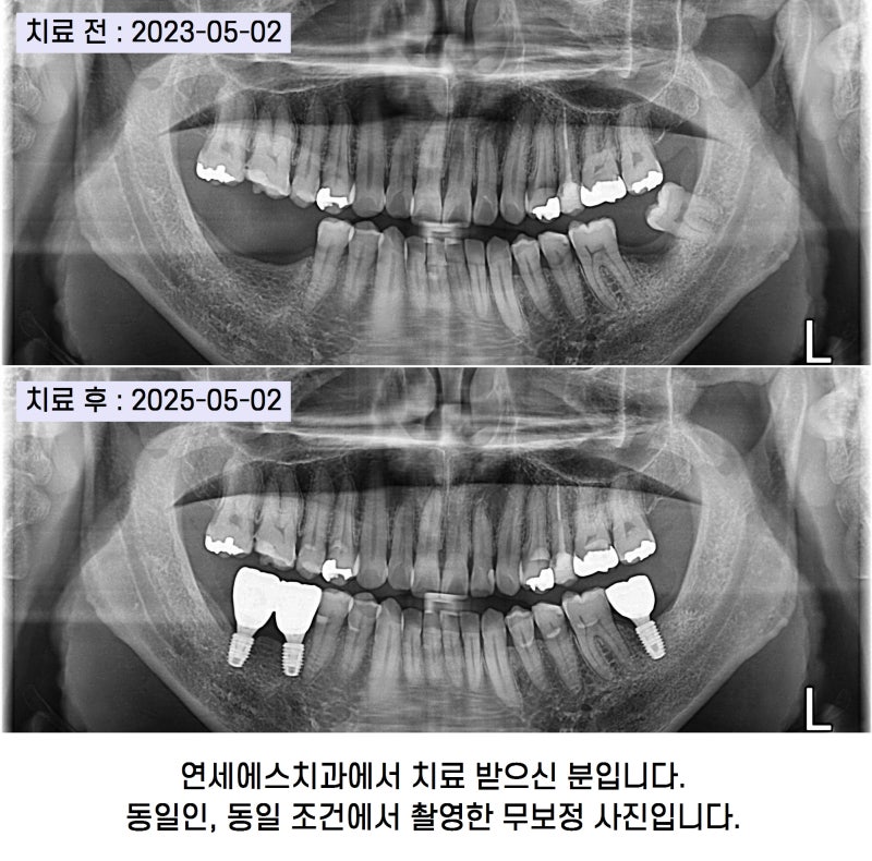 어금니 발치 후 식사 불편할 때, 치아 상실 임플란트