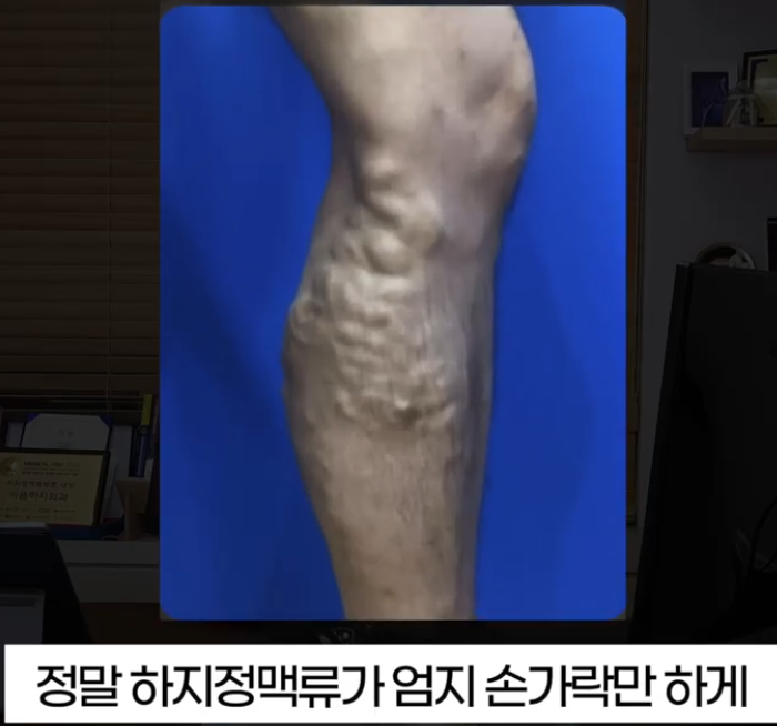 하지정맥류 수술 마취가 걱정된다면? 주의 사항 3가지