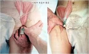 사타구니 허벅지 통증
