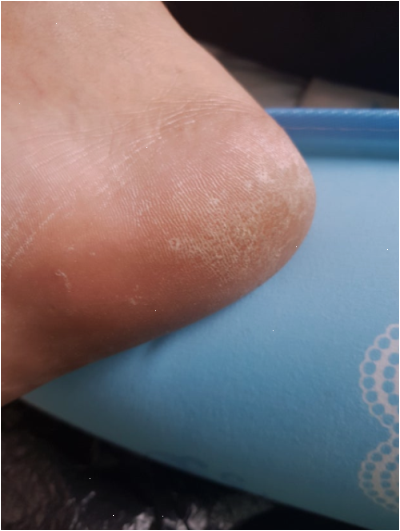 발바닥독소패치 붙이던 내 발 비포애프터