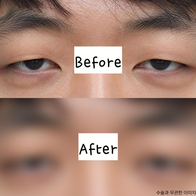 남자 무쌍 눈매교정, 절개 눈매교정술 해도 하나도 안 느끼하네