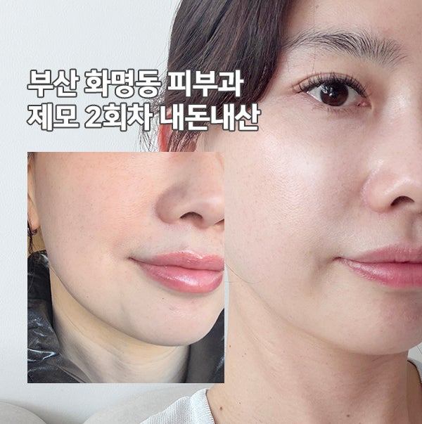 부산 얼굴 레이저 제모 피부과 2회차 젠틀맥스 프로플러스 후기