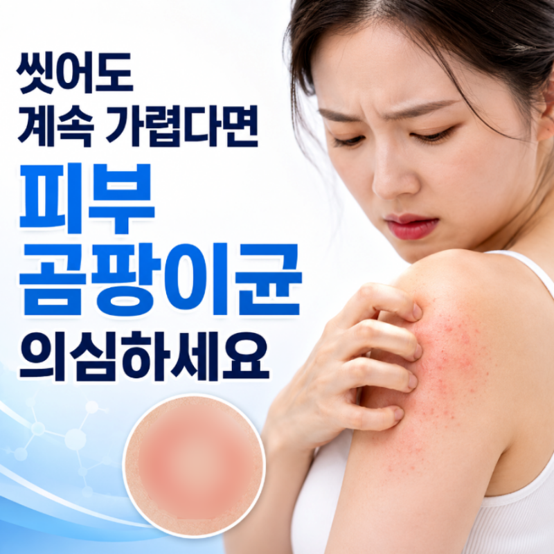 피부 곰팡이 감염 증상 어루러기 치료