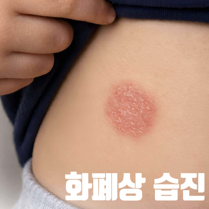 동전모양 화폐상 습진, 원인 증상 치료, 백선 완선 차이
