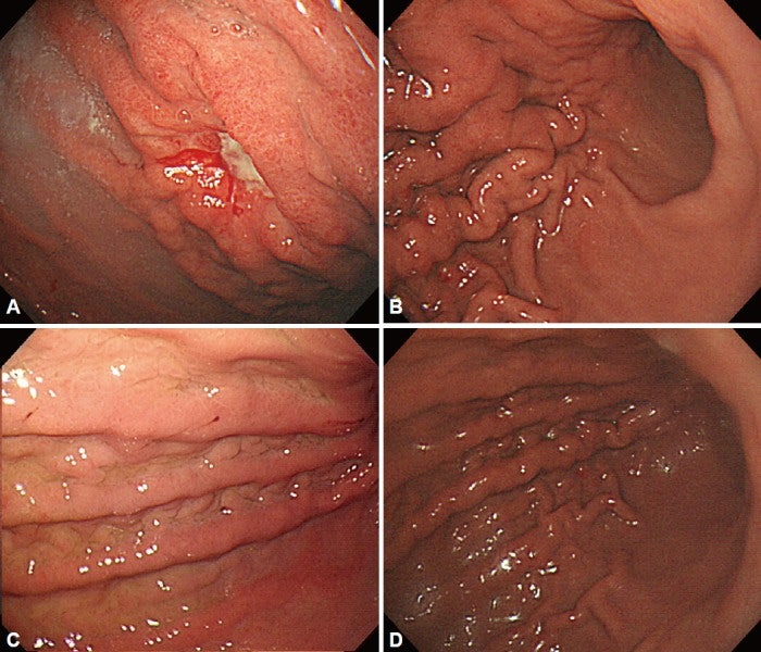 보르만 제4형 진행성 위암(Borrmann type IV advanced gastric cancer)
