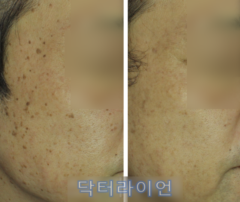 편평사마귀, 제거했는데 왜 다시 생길까요? 재발과 잔존의 차이(피부과전문의 치료법)