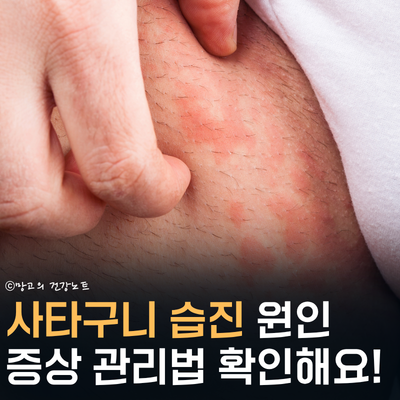 가려움, 진물? 사타구니 습진 증상 원인 및 관리법 확인해요!