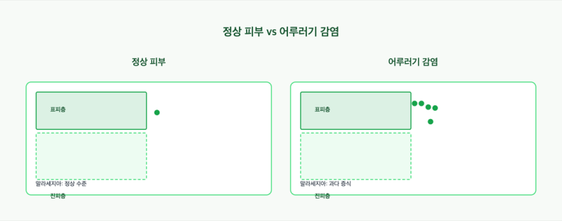 "가렵지도 않은데 피부가 얼룩덜룩?!" 2026 여름 어루러기(전풍) 원인·무좀 구분·치료·예방 ....