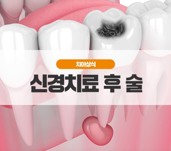 [음성 선플란트치과]신경치료 후 술마셔도 되나요?