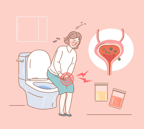방광염 초기 증상과 원인｜여성에게 자주 생기는 이유는?