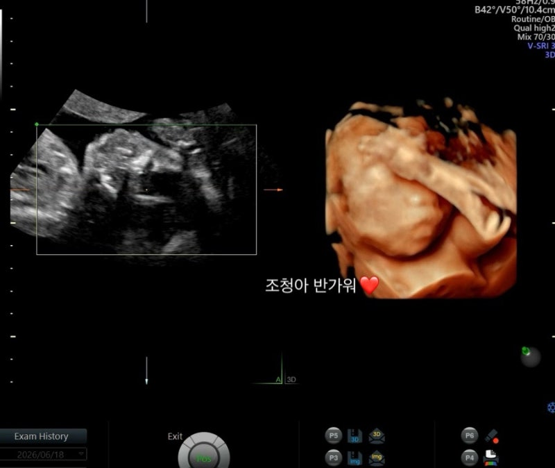 [임신기록] 17주~21주 임신 증상 / 임산부 위경련 / 태동시기 / 정밀초음파 / 소복효소 내돈내산....