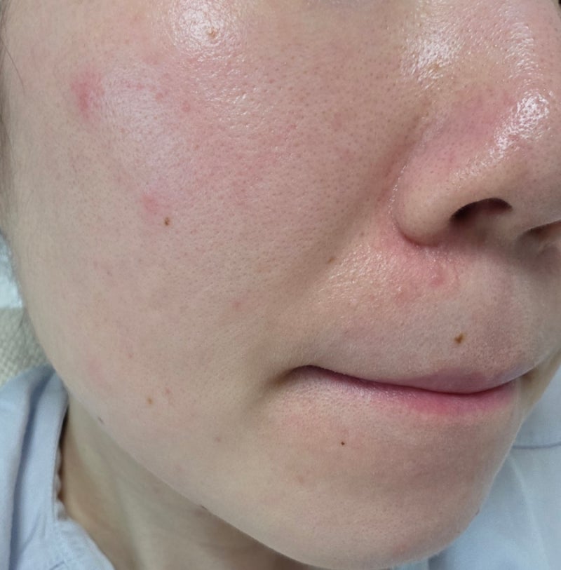 주사피부염 수란트라 연고 2달 차 후기