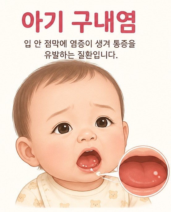 아기 구내염, 열이 날 때 대처법