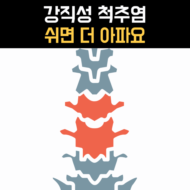 강직성 척추염 증상, 쉬면 더 아프고 움직이면 편해지는 허리통증