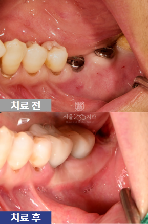 어금니 임플란트 하고 잇몸 내려앉음-FGG잇몸이식술이 답인이유