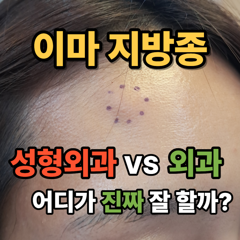 이마 지방종 제거, 성형외과 vs 외과 어디가 잘할까?