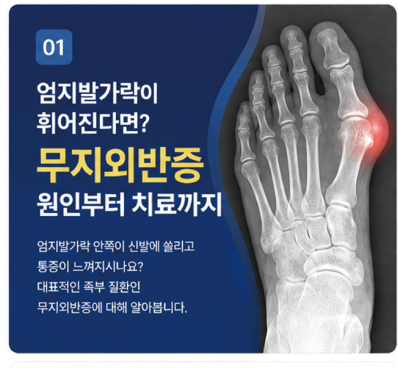 무지외반증, 원인부터 치료, 자가진단 총정리[영등포정형외과]