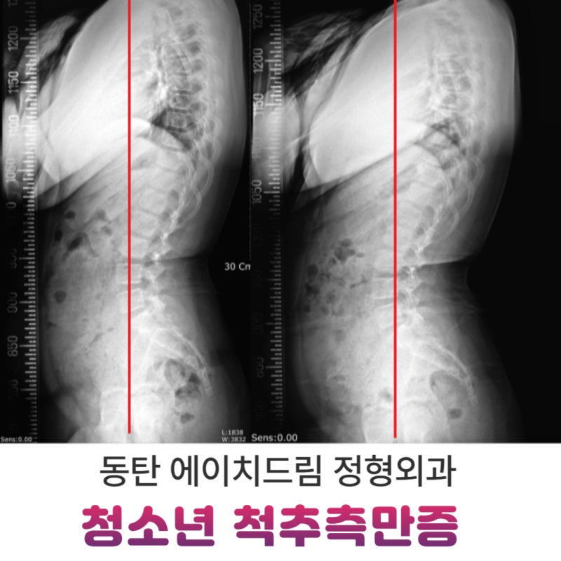 청소년 척추측만증, 진단부터 치료까지 한 번에 정리한 5가지 핵심