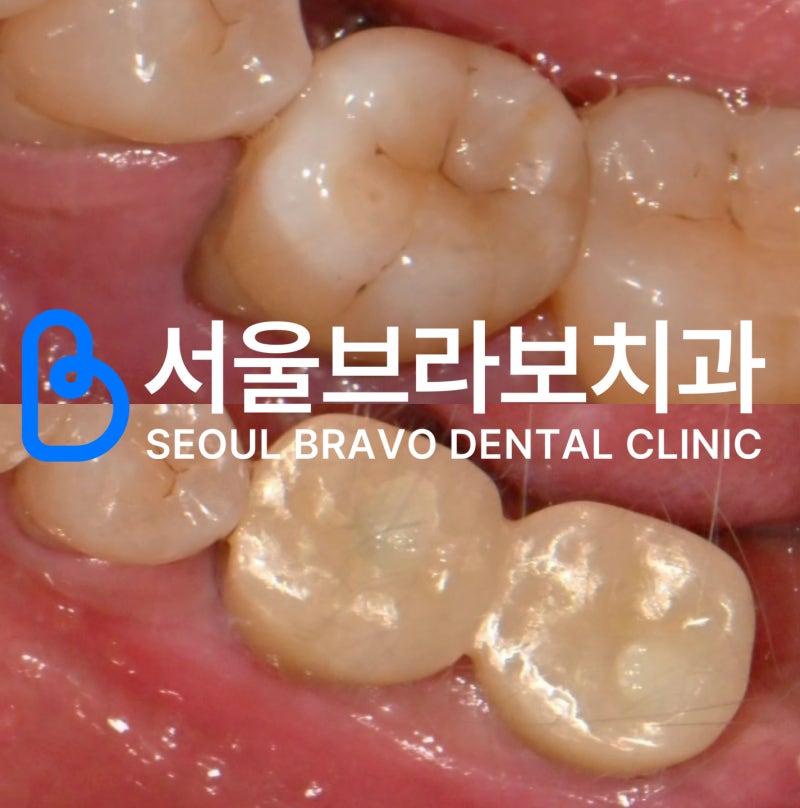 치주염이 심한 경우 임플란트, 뼈이식부터 해야 하는 이유