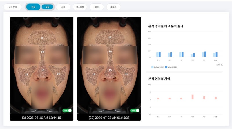 VT 리들샷 100 효과, 5주 넘게 발라본 결과 | 마크뷰 전후 비교 후기