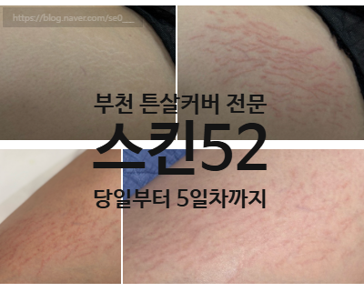 튼살없애는법, 부천 스킨52 튼살커버 6일차 솔직후기