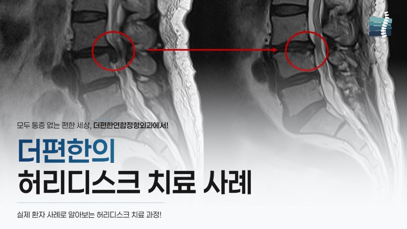 대구 허리디스크 병원, 실제 환자 사례로 알아보는 치료 과정 (정형외과 전문의 작성)