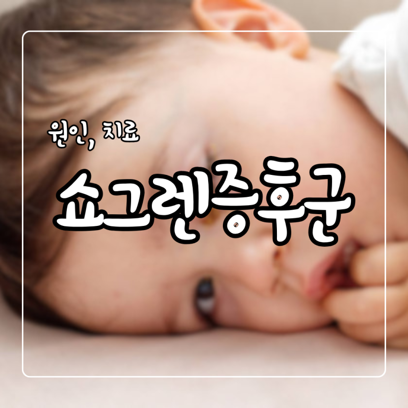 쇼그렌증후군 원인 증상 치료 검사