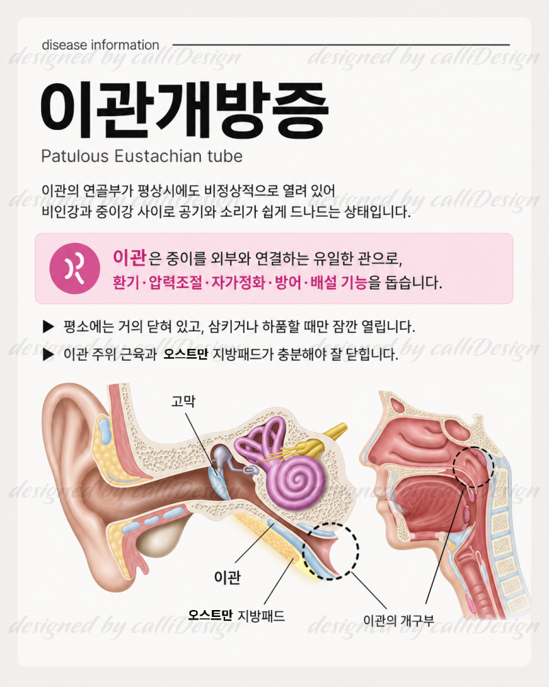 이관개방증? 생활관리법은?