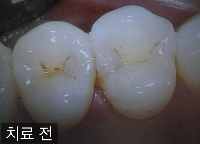 레진 인레이 가격, 얼마가 적정선일까? 가격/ 후기/ 장점/ 단점 총정리! [공덕 충치 치과]
