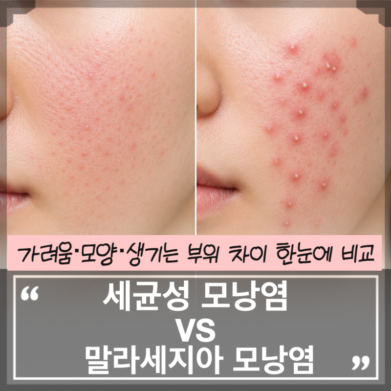 세균성·진균성(말라세지아) 모낭염 구별법｜가려움·모양·생기는 부위 차이