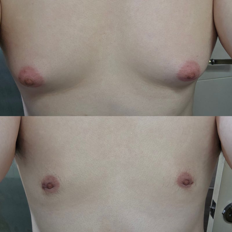 [교대역 연세리즈의원] 강남 여유증 수술 후기 및 가격 실비 보험 모조리 알려준다, 나 납작....